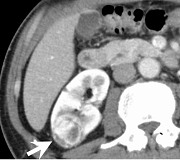 造影 dynamic CT 動脈相