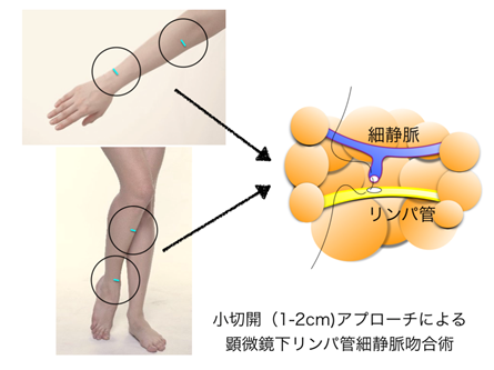 最先端の超低侵襲・超微細手術
