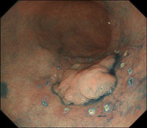 腫瘍の周囲にマーキングした時の様子