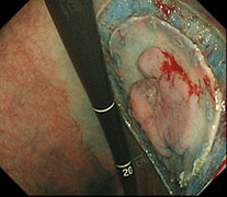 周囲を高周波ナイフで切開した時の様子