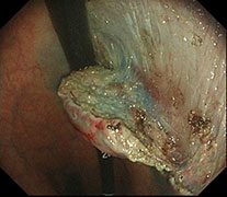 腫瘍の深部で剥離させた時の様子