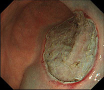 腫瘍を一括で摘出する時の様子