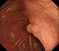 小さな早期大腸癌の写真
