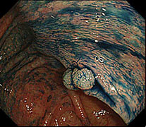 色素散布した様子