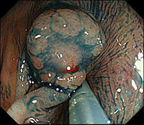 がんを疑う陥凹の写真