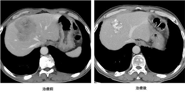 抗がん剤治療により切除可能となった肝転移のMRI写真