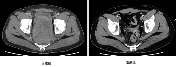 抗がん剤治療により切除可能となった巨大直腸がんのMRI写真