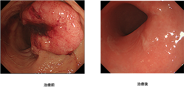 抗がん剤＋放射線治療により進行直腸がんが消失した様子