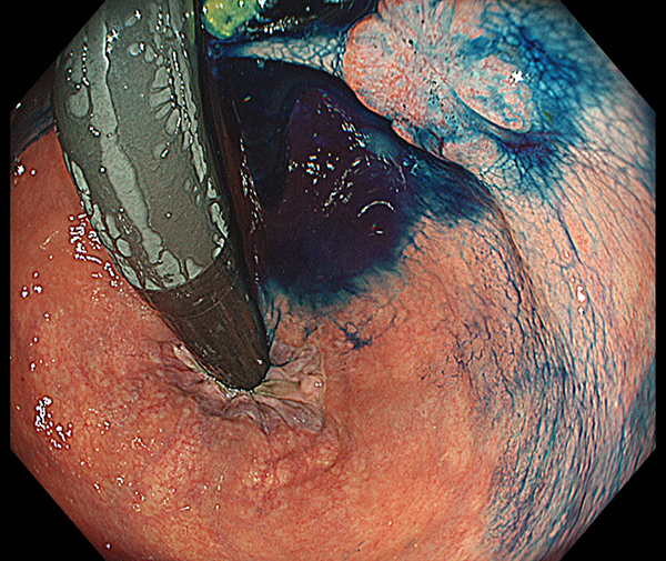 従来ならば一時的人工肛門が必要であった下部直腸がんの症例写真