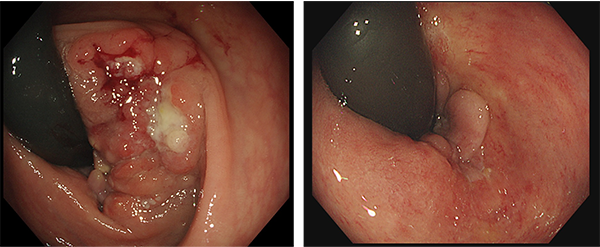 TS-1+MMC療法によりがんが消失した肛門管扁平上皮がんの写真