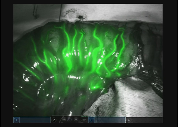 赤外線蛍光波長で腸管の血流を確認している様子