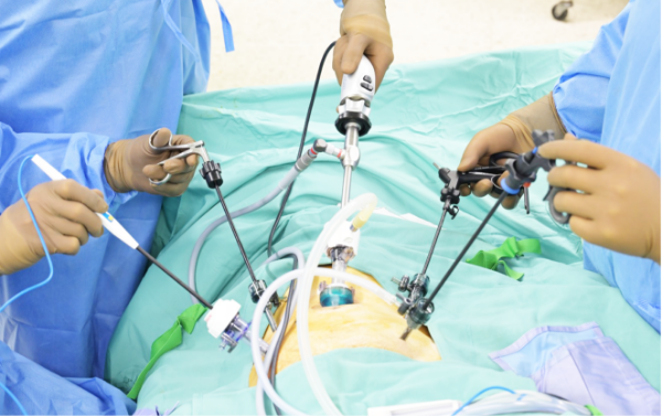 腹腔鏡下手術の様子