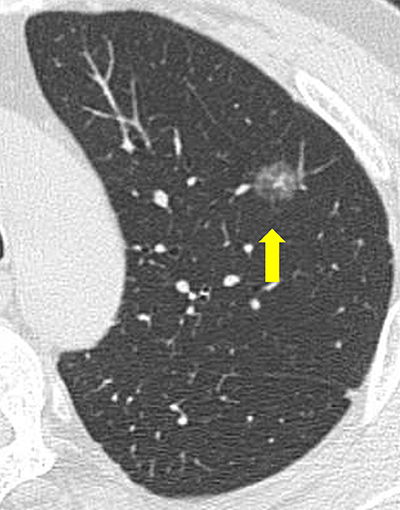 CTでみつかる淡いスリガラス結節