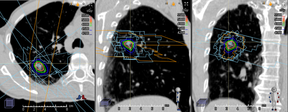 体幹部定位照射の様子