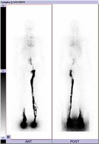 リンパシンチグラフィー写真