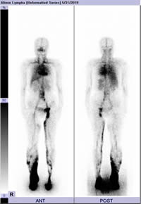 リンパシンチグラフィー写真