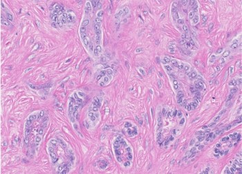 肝内胆管癌の組織像