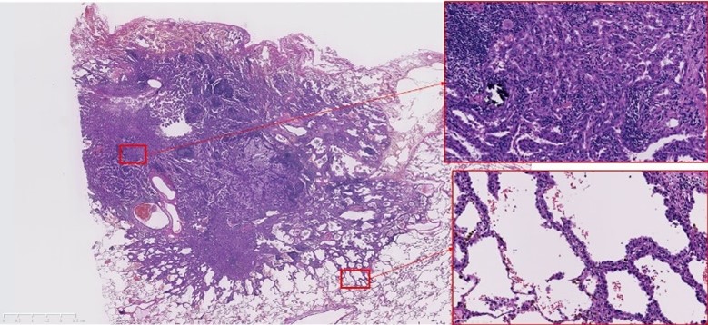 同一の肺腺癌であっても部位により組織像が異なる