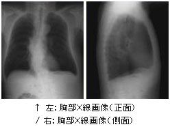 胸部X線検査